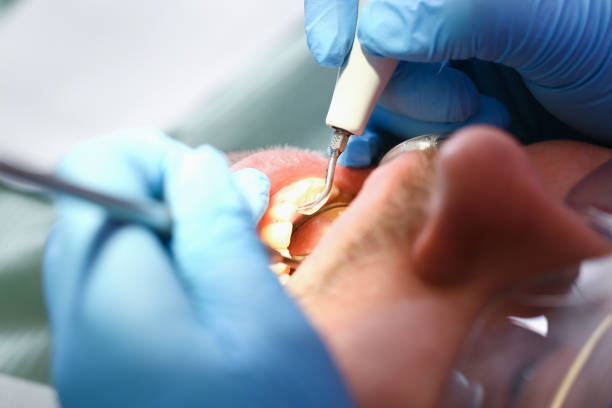 Best Emergency Tooth Extraction in Independence, IA